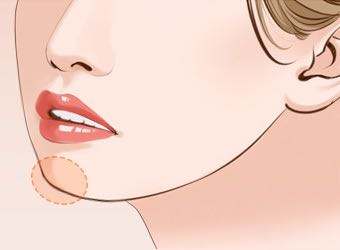 达拉斯隆鼻会不会又后遗症