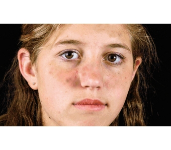 上海美莱申涛主任:关于玻尿酸注射的基础知识解析