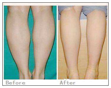 水光针补水效果真的好吗