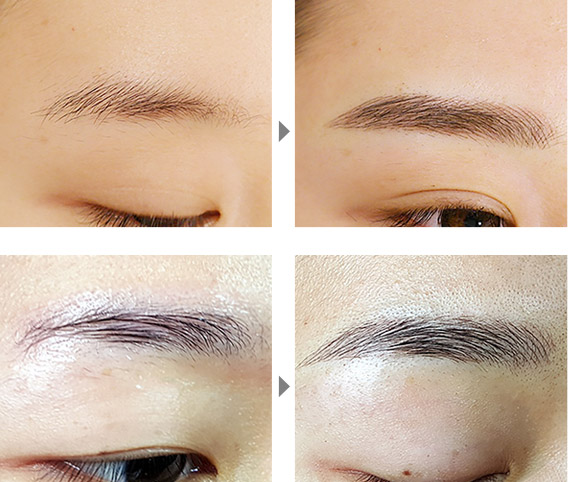 上海美莱注射瘦肩针,瘦肩针摆脱虎背熊腰