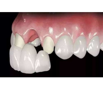 美莱吸脂减肥效果好不好