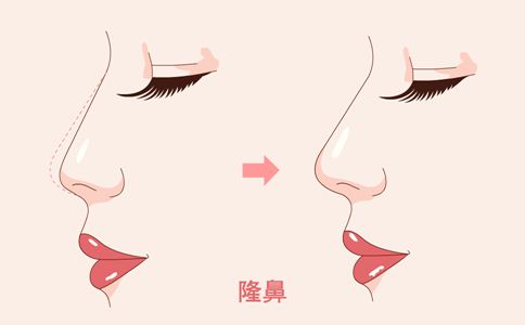 乔雅登玻尿酸上海美莱买一送一