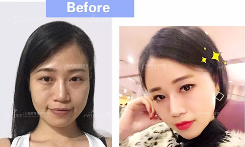 乔雅登玻尿酸<a href='/' target='_blank'><u>上海美莱</u></a>买一送一