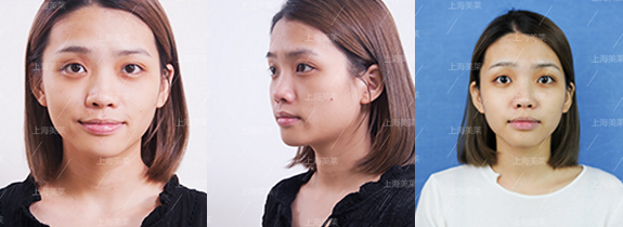 皮秒激光祛雀斑会不会反弹