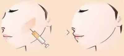 脸上黄褐斑越来越多怎么办