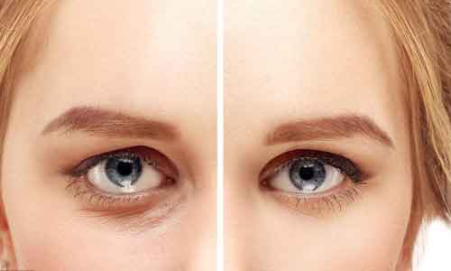 上海美莱彩光祛斑效果怎么样