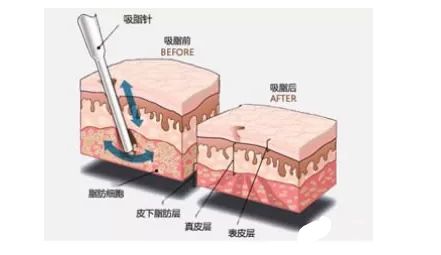 上海美莱“乔雅登玻尿酸”我的美天生力致活动美丽举行