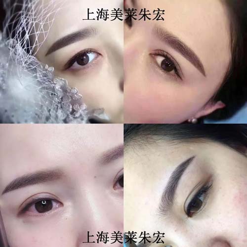 上海冰点脱毛的医院哪家好