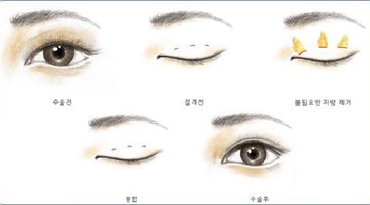 鲁峰携SVF-gel专利技术落户上海美莱,开启脂肪管理峰会