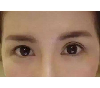 法令纹很深太显老了，怎么消除