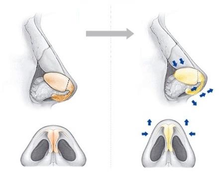 上海玻尿酸丰唇哪个医院效果好