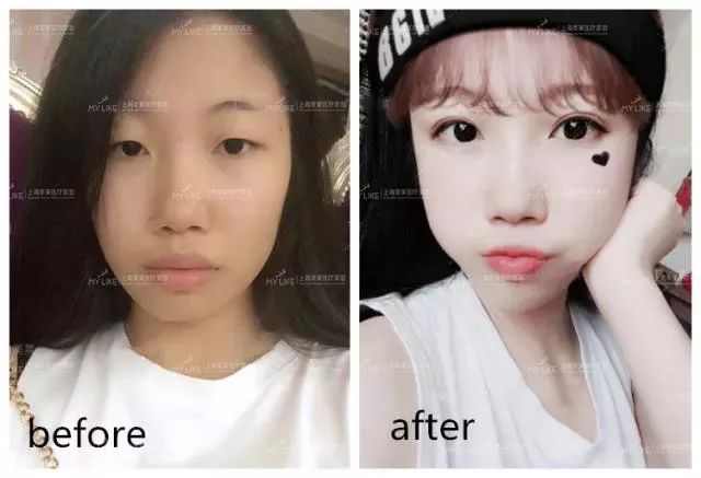 上海正规隆胸医院哪家好