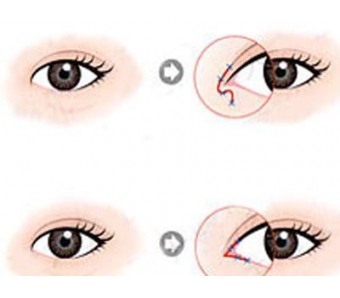 上海美莱暑期"牙齿矫正奖学金"，分数当钱用