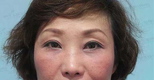 双眼皮手术失败，应该怎么办啊