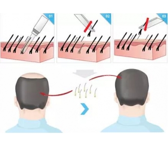 <a href='/' target='_blank'><u>上海美莱</u></a>悦升线线雕除皱,明星年轻的秘密