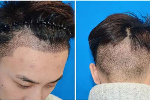 菲蜜丽私密整形效果好吗