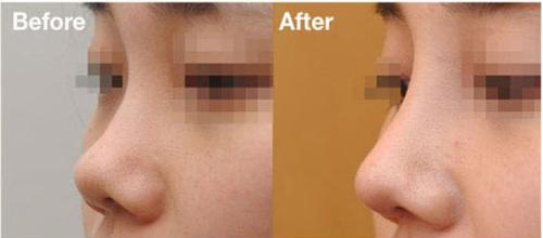 面部毛孔特别粗大什么方法可以改善