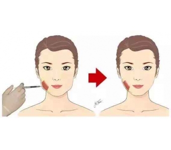 美莱口腔发布隐适美牙齿矫正产品iGO