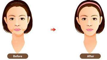 美莱口腔发布隐适美牙齿矫正产品iGO