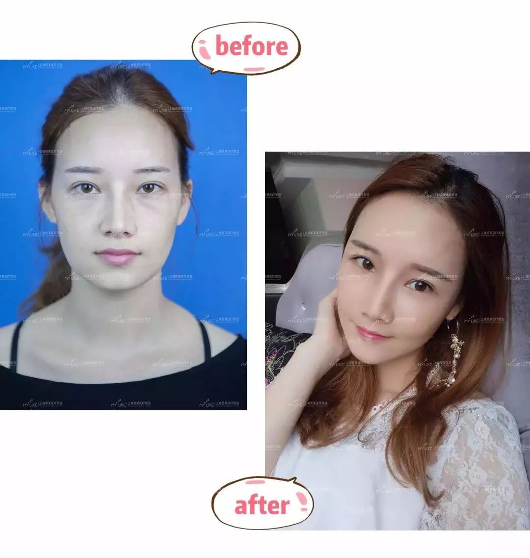 上海哪家医院做超皮秒祛斑