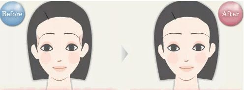 牙齿黄做牙贴面能美白吗