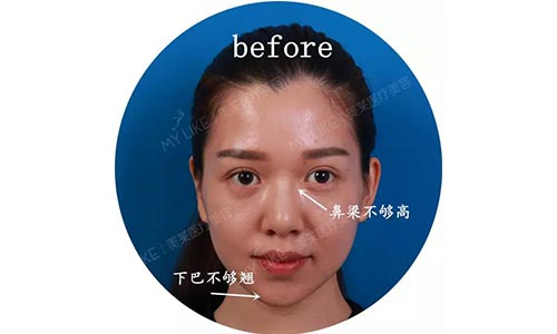 上海美莱隆胸怎么样