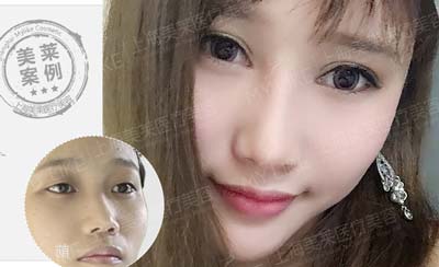 上海做假体隆鼻手术大概价格多少钱