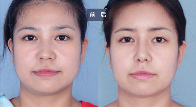 上海美莱「中秋爱牙日」牙齿矫正可减13800元