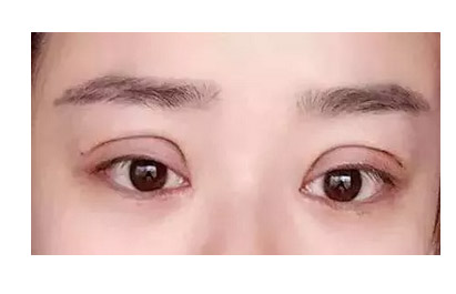<a href='/' target='_blank'><u>上海美莱</u></a>韩式双眼皮过程是怎样的