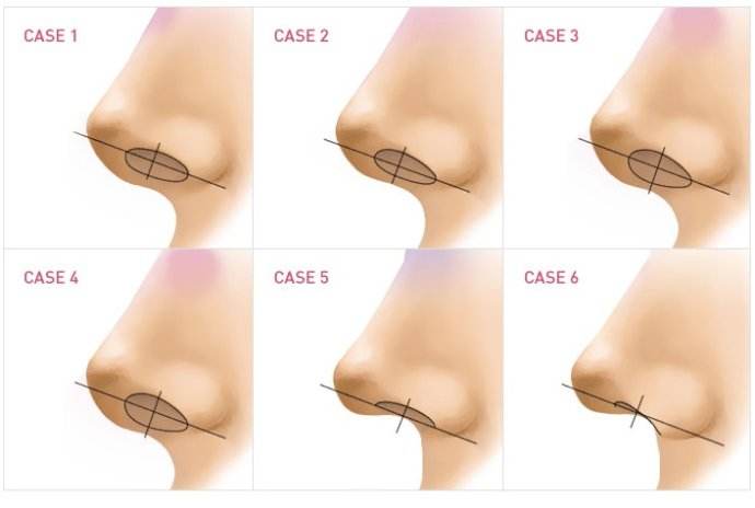 美莱双眼皮、隆鼻整形7.7折,眼部整形立减1000元