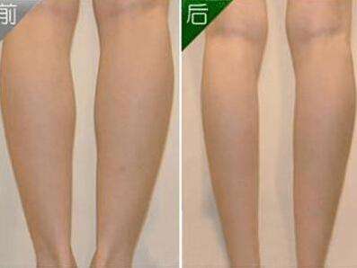 上海美莱假体丰胸整形手术价格贵吗