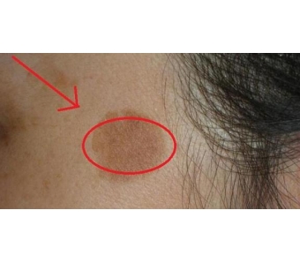 美莱注射水光针, 告别假期“油光肌”