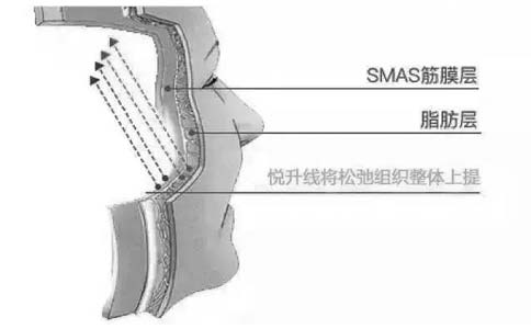 打美肤针美白效果好不好