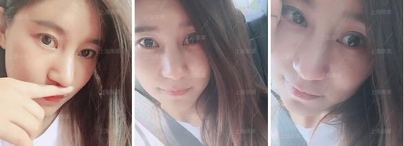 美莱携手高德美皮下玻尿酸填充进修班