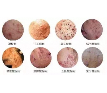 美莱携手高德美皮下玻尿酸填充进修班