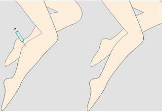 韩式去眼袋手术会不会留疤