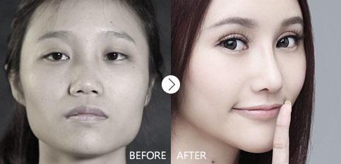 11月4日-5日“达拉斯隆鼻整形开创者”李战强教授坐诊美莱