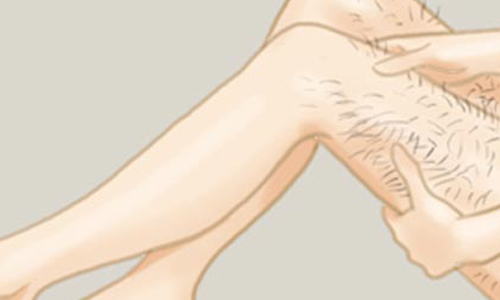 上海激光去黄褐斑一般多少钱