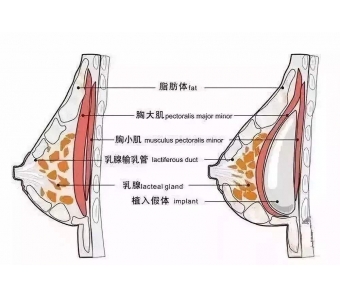玻尿酸注射隆鼻效果能保持多久