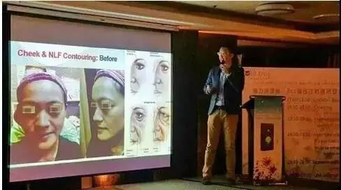 玻尿酸隆鼻会不会留疤呢