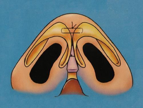 腰部两侧赘肉怎么才能快速减掉