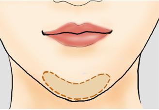 哪些人适合做埋线双眼皮