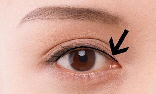 正规医院做隆胸假体取出需要多少钱啊