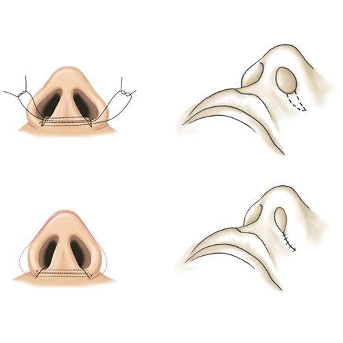 大脸打瘦脸针真的可以瘦下来吗