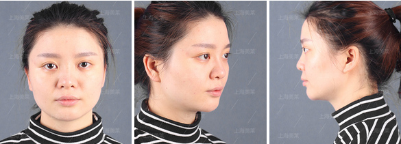 玻尿酸隆鼻需要几支玻尿酸