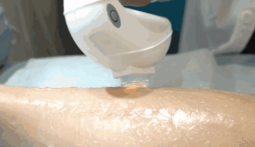 去眼袋术后需要多长时间才能恢复