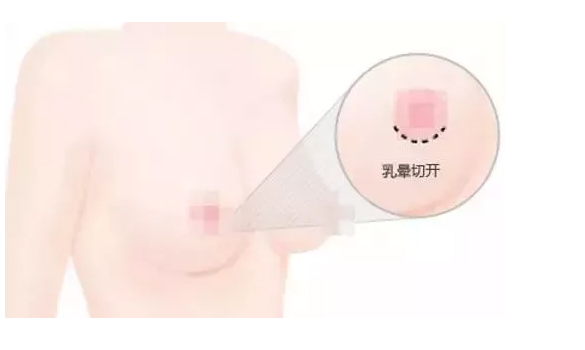 膨体隆鼻术后一般要多久才能恢复自然啊