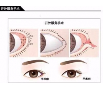 脸上的雀斑很多要怎么才能去除啊