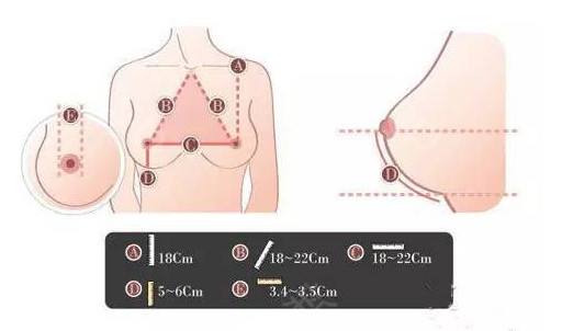 上海做假体丰胸整形手术可靠吗