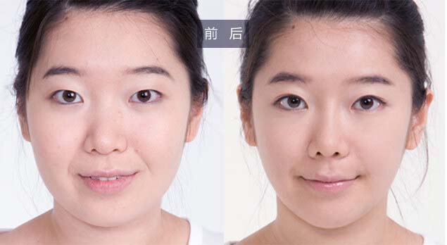 做完自体脂肪隆胸的手感好不好呢